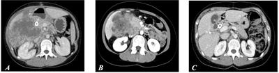 Case report: Complete pathologic response with first-line immunotherapy combination in a young adult with massive liver dissemination of mismatch repair–deficient metastatic colorectal cancer: Immunological and molecular profiling